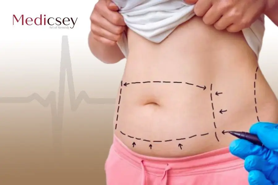 Liposuction VS a Tummy Tuck The Pros and Cons in 2023